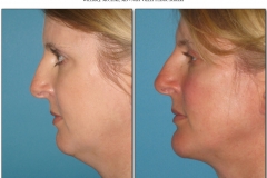 Chin-Implant.002