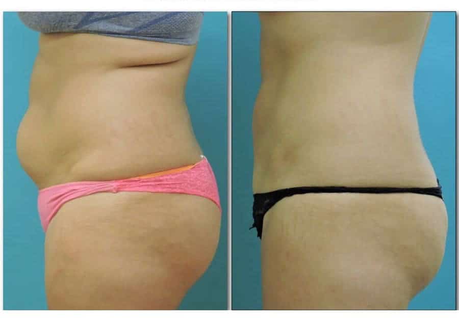 Liposuction.003-body