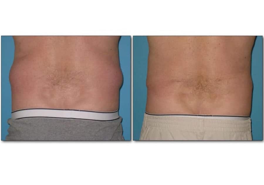 Liposuction.004-body