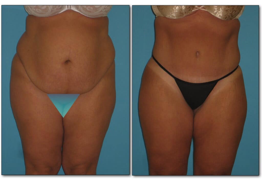 Before and after photo showing abdominal contour improvement from body procedures