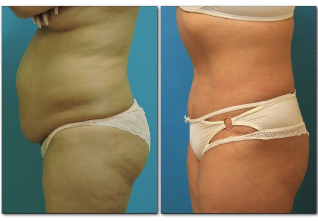 body-procedure-plastic-surgery-3