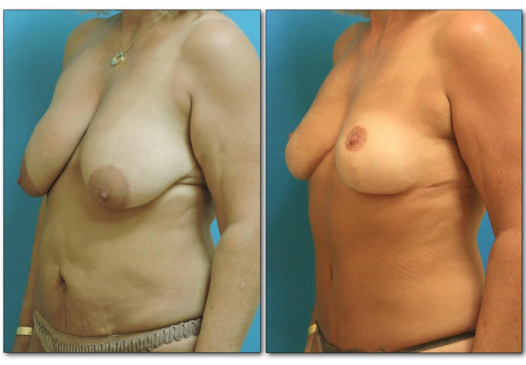 body-procedure-plastic-surgery-4