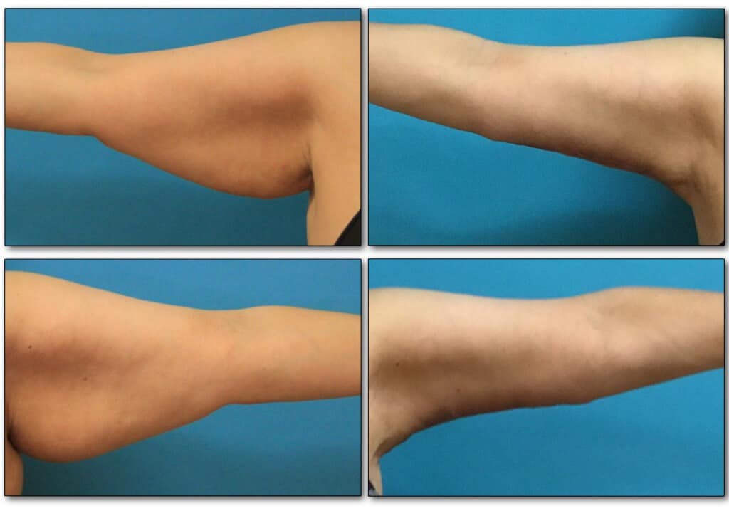 body-procedure-plastic-surgery-5