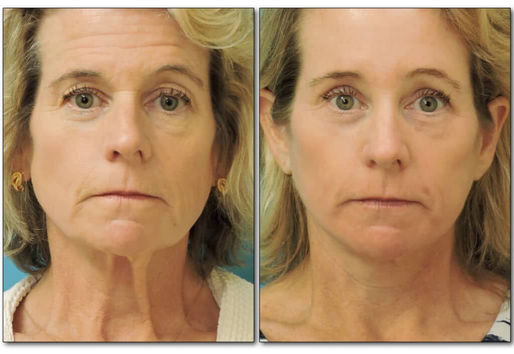 browlift-plastic-surgery-1