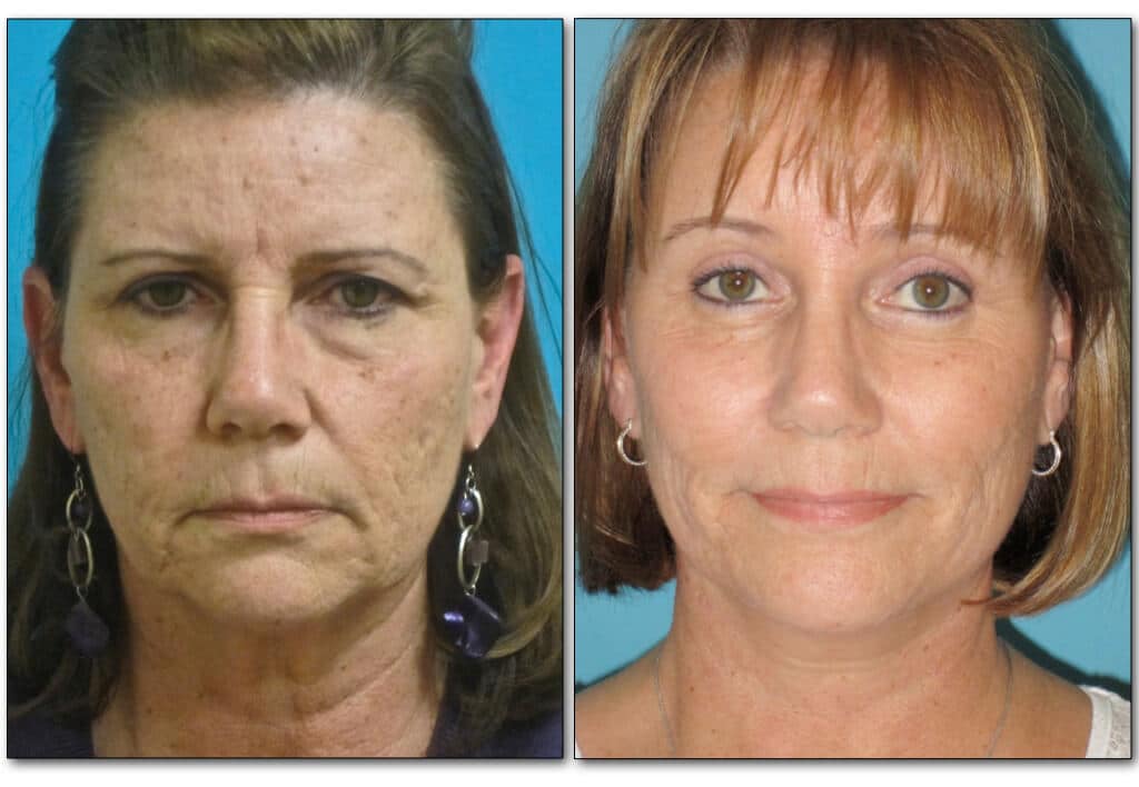 browlift-plastic-surgery-2