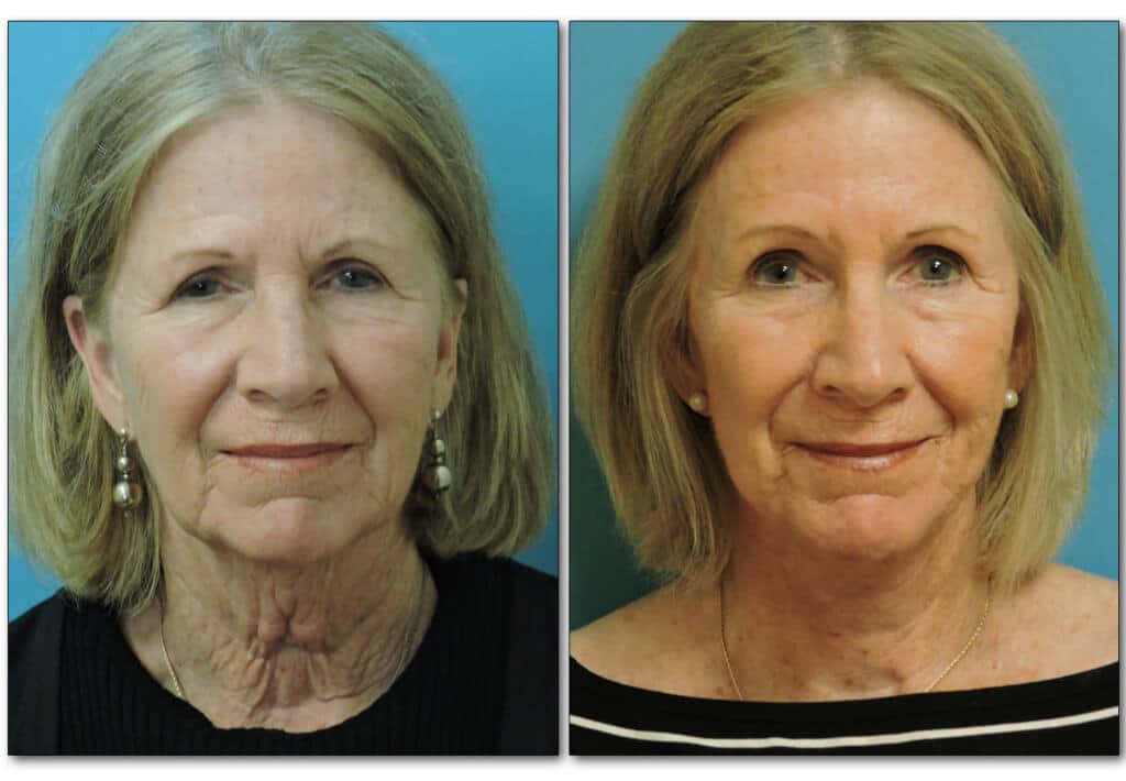 browlift-plastic-surgery-3