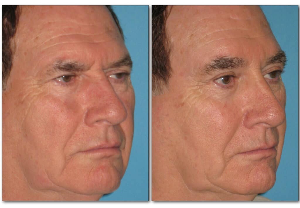 browlift-plastic-surgery-4