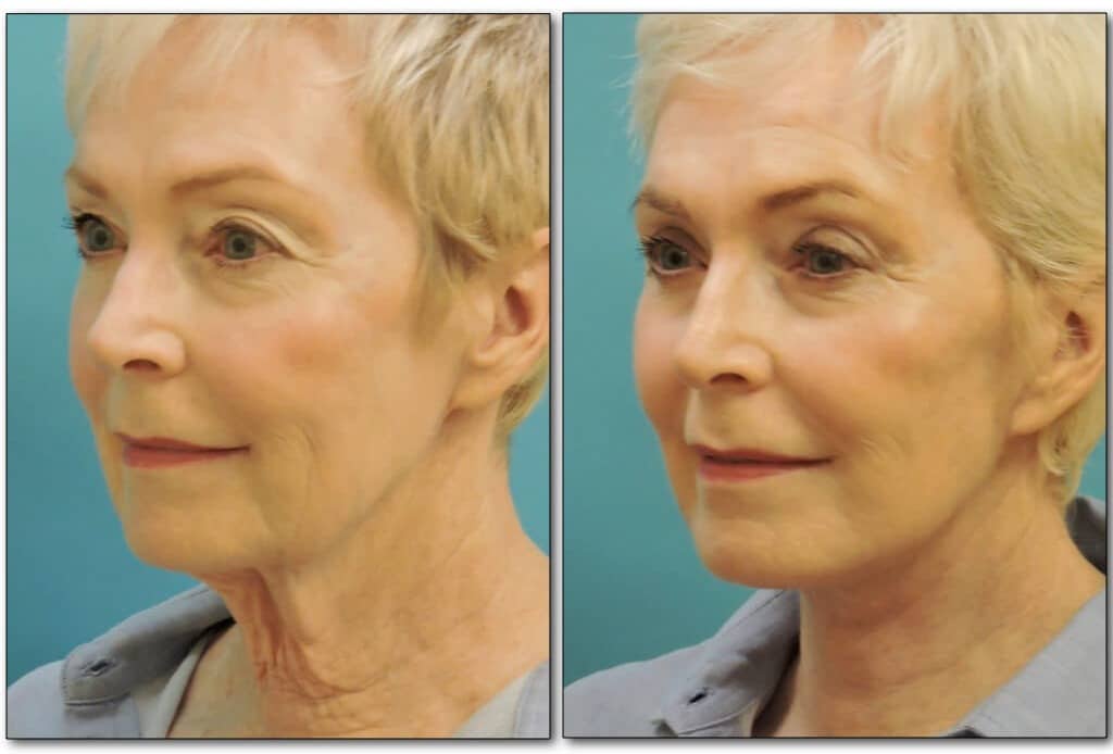 eyelids-plastic-surgery-1