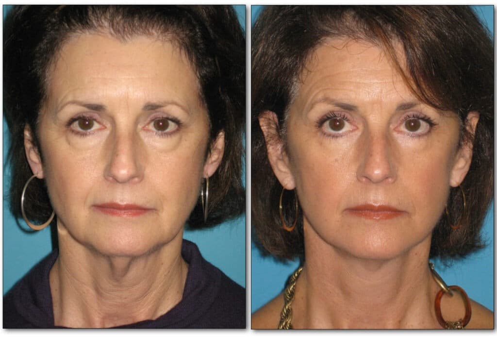 eyelids-plastic-surgery-2