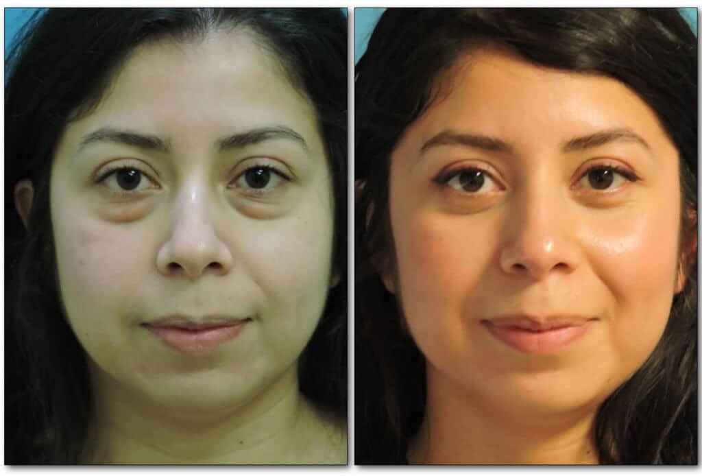 eyelids-plastic-surgery-3