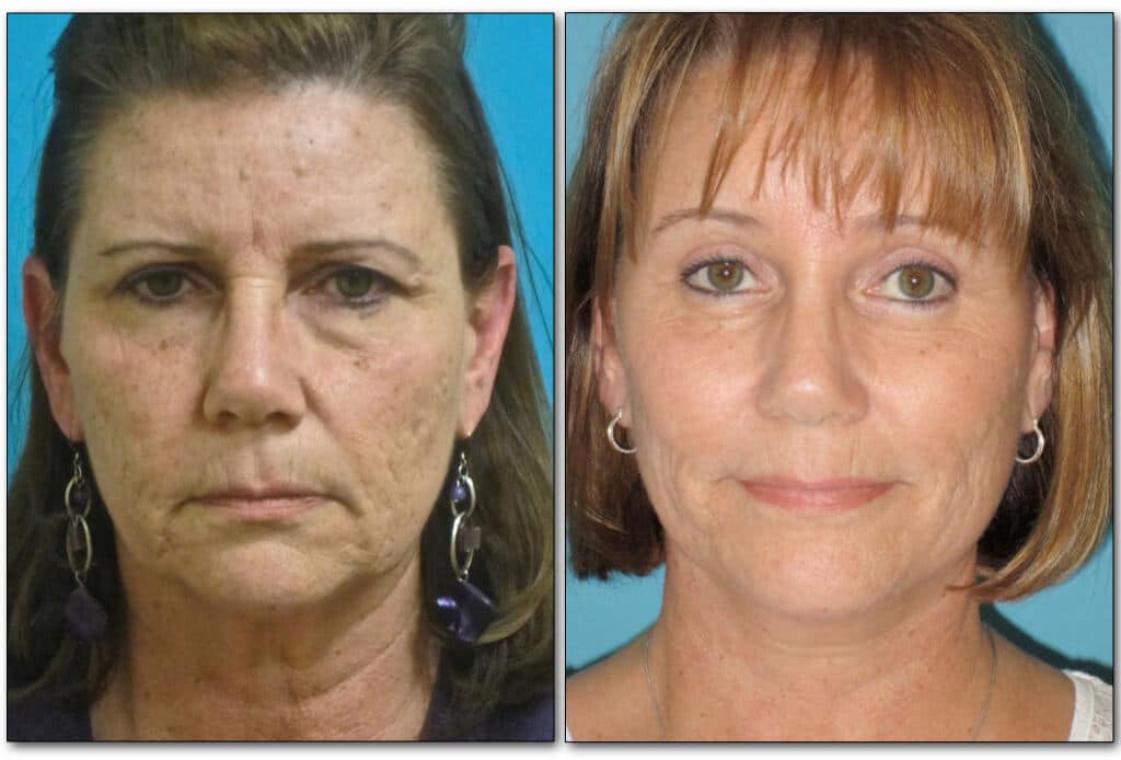 Before and after eyelid surgery showing rejuvenated, more alert appearance in middle-aged woman.