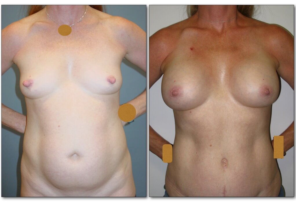 mommy-makeover-plastic-surgery-3