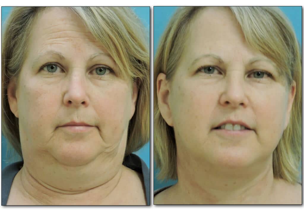 Front and side comparison after neck liposuction highlighting smoother neck contour and tighter skin