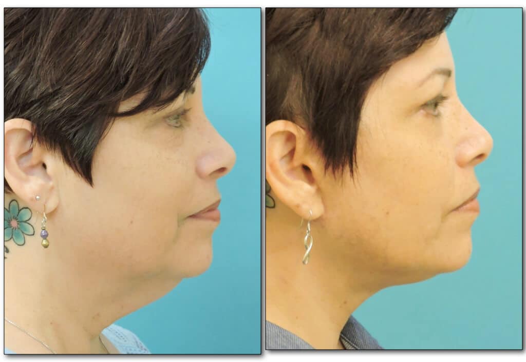 Side profile before and after neck liposuction with visible reduction in neck fat and enhanced chin definition