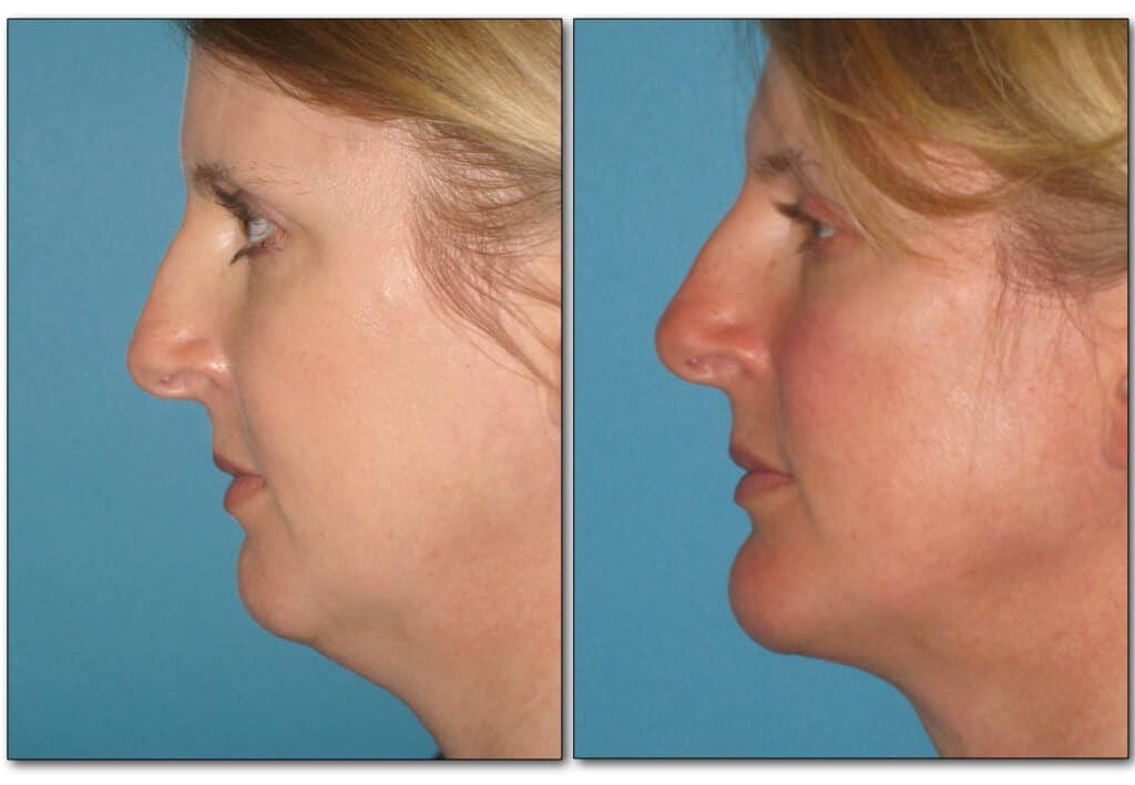 neck-liposuction-3