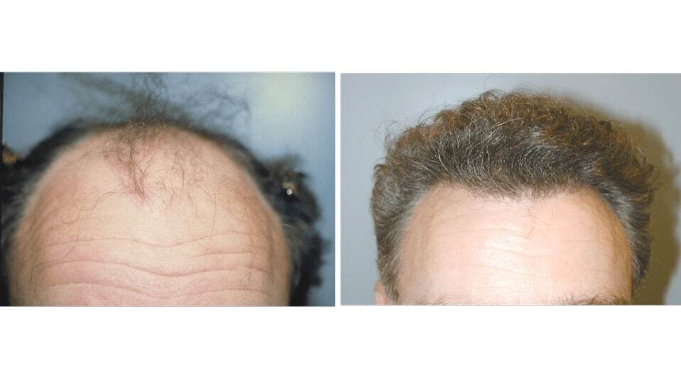 Before and after male hair transplant showing restored hairline and thickness.