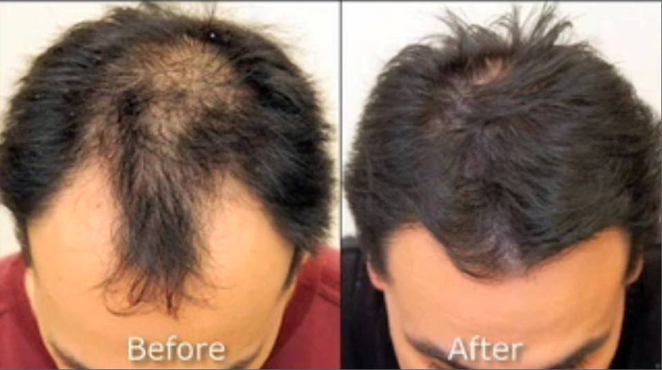 Before and after results of male hair restoration showing fuller scalp coverage.