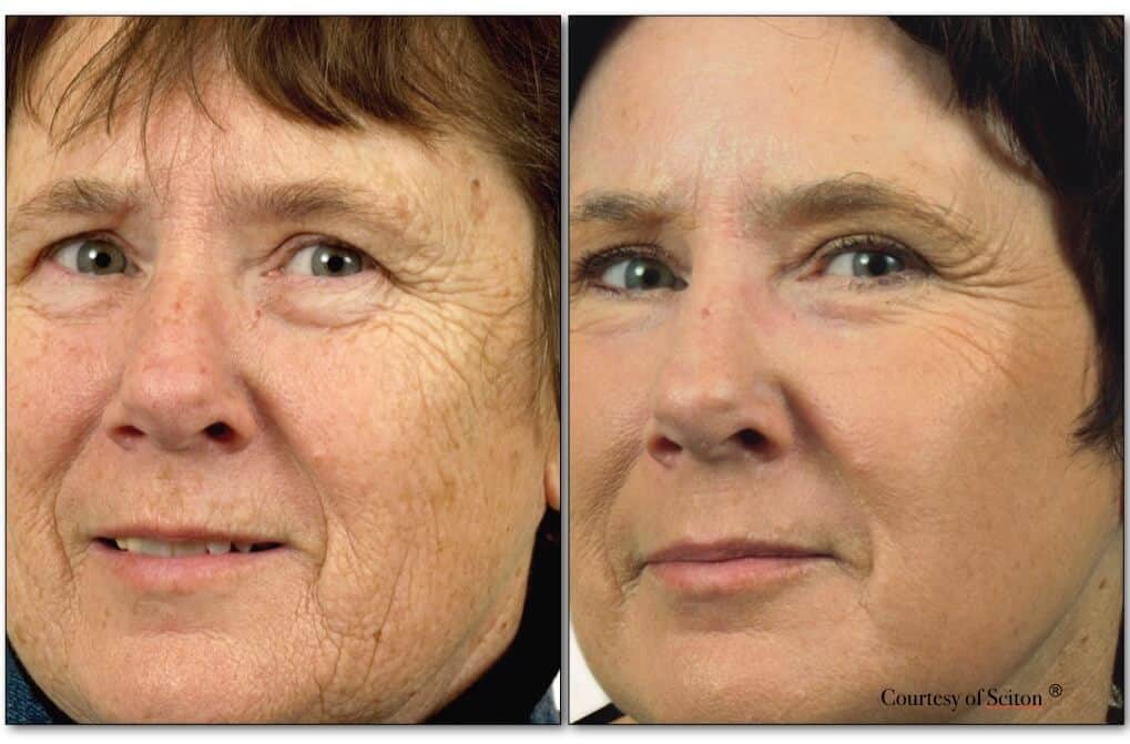 Before and after SCITON® Erbium Laser Skin Resurfacing showing smoother, younger-looking skin on female patient’s face.