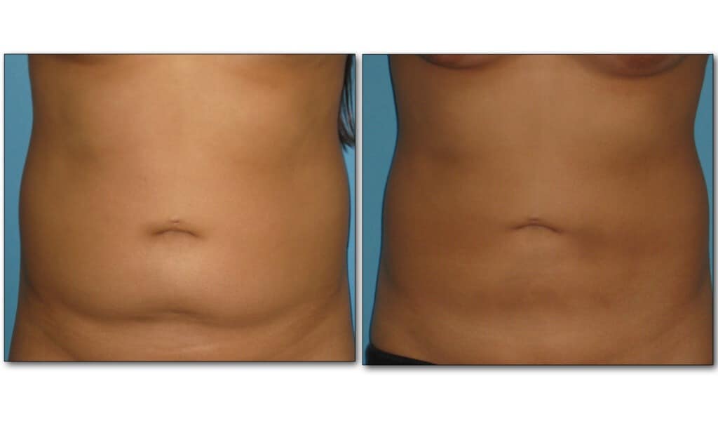 Liposuction 2