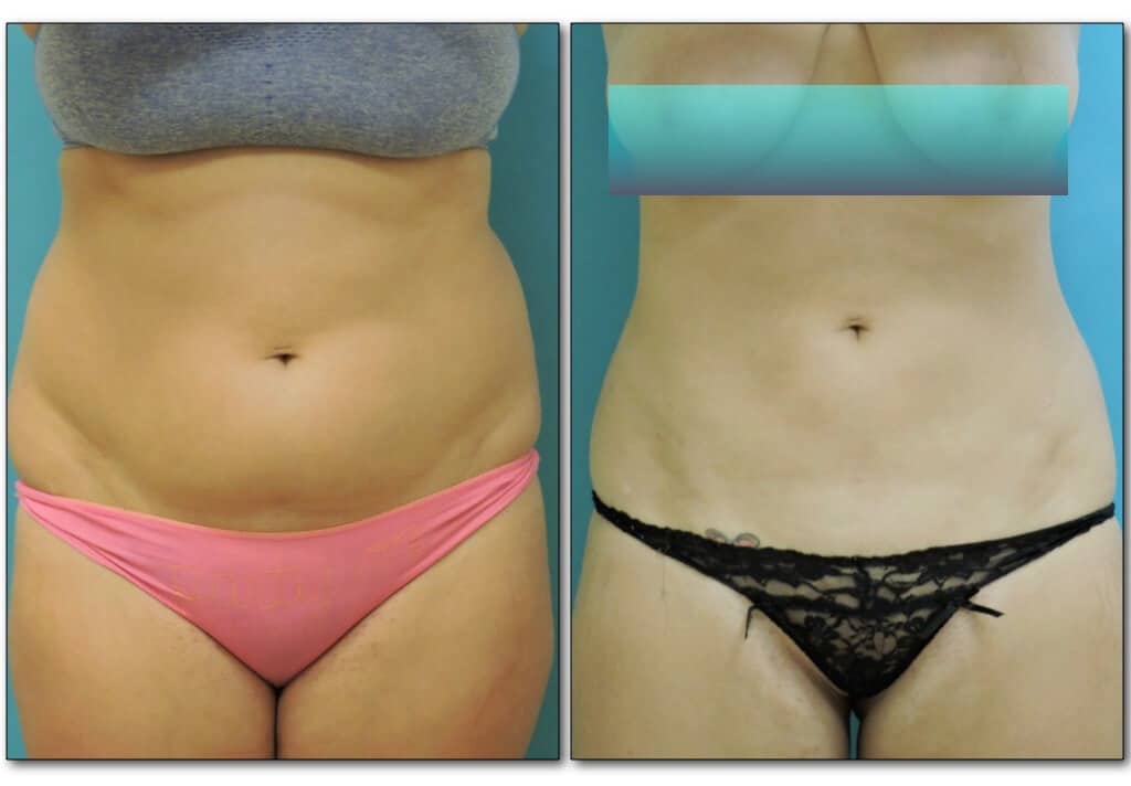 Before and after liposuction showing slimmer, more contoured abdomen.