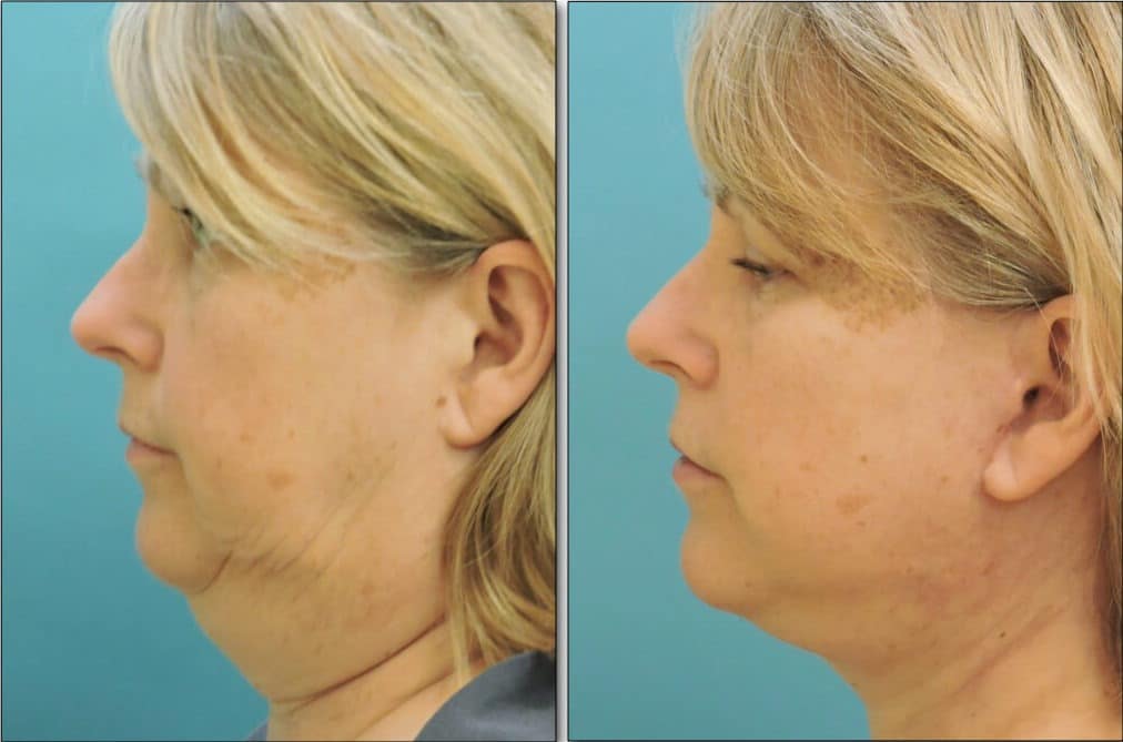 Before and after neck liposuction showing improved jawline definition and reduced double chin in middle-aged woman.