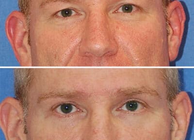 Blepharoplasty Patient