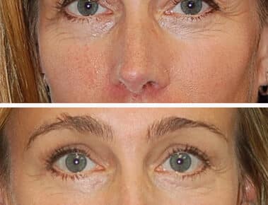Blepharoplasty Patient – 11