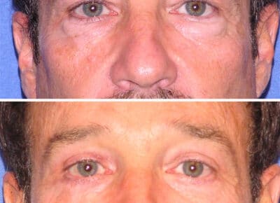 Blepharoplasty Patient – 8