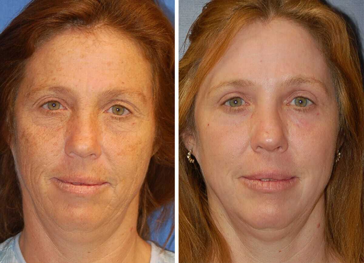 snyder erbium laser resurfacing before and after patient photo