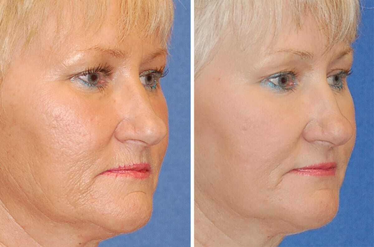 Before and after SCITON® Erbium Laser Skin Resurfacing treatment reducing wrinkles and improving skin texture on woman’s face.