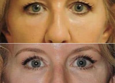 Blepharoplasty Patient – 6