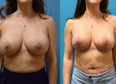 Breast Procedure Patient 8