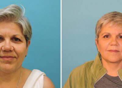Blepharoplasty and Browlift Patient 1