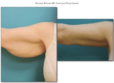 Brachioplasty – Dr. McClure 2