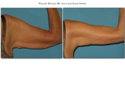 Brachioplasty – Dr. McClure 4