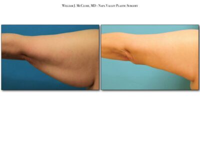 Brachioplasty – Dr. McClure 5