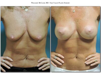 Breast Lift with Implants – Dr. McClure 2