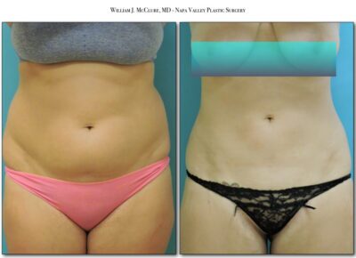 Liposuction – Dr. McClure 1