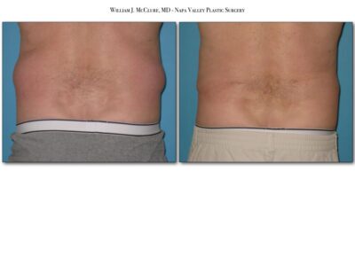 Liposuction – Dr. McClure 2