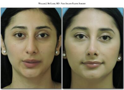 Rhinoplasty – Dr. McClure 2