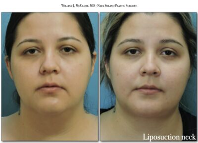 Liposuction – Dr. McClure 4
