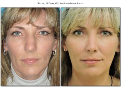 Rhinoplasty – Dr. McClure 1