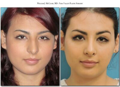 Rhinoplasty – Dr. McClure 3