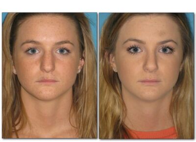 Rhinoplasty – Dr. McClure 6