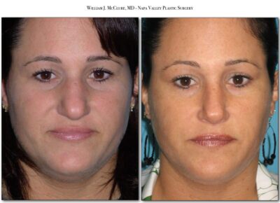 Rhinoplasty – Dr. McClure 7