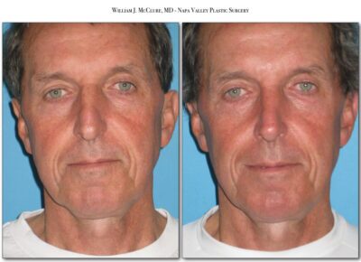 Rhinoplasty – Dr. McClure 8