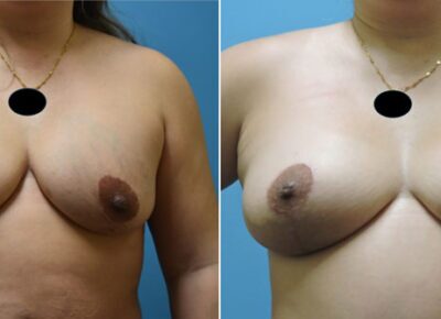 Breast Procedure Patient 11