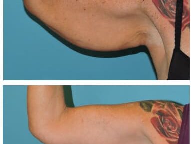 Brachioplasty – Dr. Snyder Patient 2