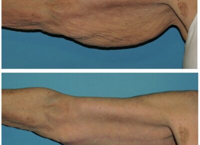 Brachioplasty – Dr. Snyder Patient 1