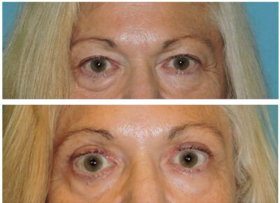 Blepharoplasty – Dr. Snyder Patient 15